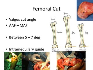 Femoral Cut
• Valgus cut angle
• AAF – MAF
• Between 5 – 7 deg
• Intramedullary guide
 