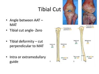 Tibial Cut
• Angle between AAT –
MAT
• Tibial cut angle- Zero
• Tibial deformity – cut
perpendicular to MAT
• Intra or extramedullary
guide
 