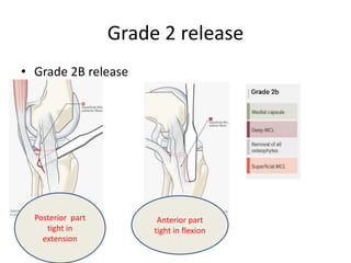Grade 2 release
• Grade 2B release
Posterior part
tight in
extension
Anterior part
tight in flexion
 
