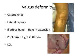 Valgus deformity
• Osteophytes
• Lateral capsule
• Iliotibial band - Tight in extension
• Popliteus – Tight in flexion
• LCL
 