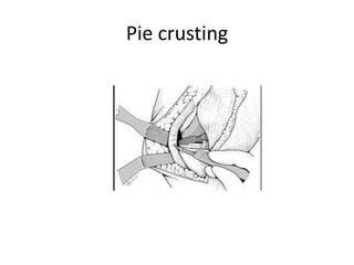 Pie crusting
 