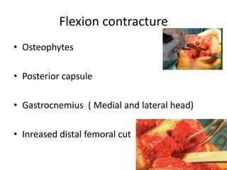 Flexion contracture
• Osteophytes
• Posterior capsule
• Gastrocnemius ( Medial and lateral head)
• Inreased distal femoral cut
 