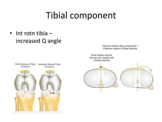 Tibial component
• Int rotn tibia –
increased Q angle
 