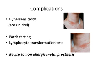 Complications
• Hypersensitivity
Rare ( nickel)
• Patch testing
• Lymphocyte transformation test
• Revise to non allergic metal prosthesis
 