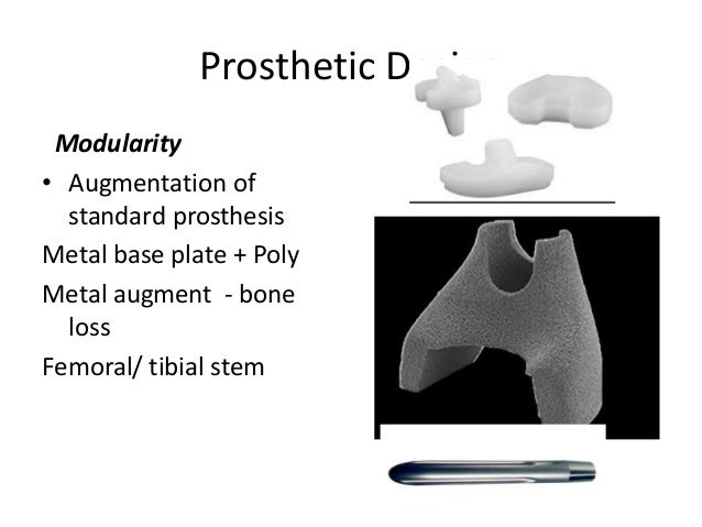 Primary Total Knee Arthroplasty - 