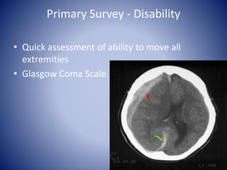 Primary Survey - Disability 
• Quick assessment of ability to move all 
extremities 
• Glasgow Coma Scale. 
 