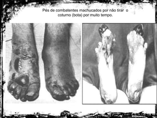 Pés de combatentes machucados por não tirar o
coturno (bota) por muito tempo.
 