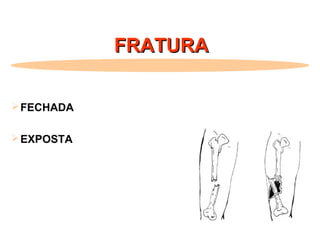 FRATURAFRATURA
FECHADA
EXPOSTA
 