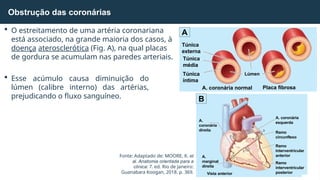  O estreitamento de uma artéria coronariana
está associado, na grande maioria dos casos, à
doença aterosclerótica (Fig. A), na qual placas
de gordura se acumulam nas paredes arteriais.
 Esse acúmulo causa diminuição do
lúmen (calibre interno) das artérias,
prejudicando o fluxo sanguíneo.
Obstrução das coronárias
A
B
Fonte: Adaptado de: MOORE, K. et
al. Anatomia orientada para a
clínica: 7. ed. Rio de Janeiro:
Guanabara Koogan, 2018. p. 369.
Túnica
externa
Túnica
média
Túnica
íntima
Lúmen
A. coronária normal Placa fibrosa
A. coronária
esquerda
Ramo
circunflexo
Ramo
interventricular
anterior
Ramo
interventricular
posterior
A.
coronária
direita
A.
marginal
direita
Vista anterior
 