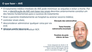  O tratamento médico imediato do AVE pode minimizar as sequelas e evitar a morte. Por
isso, a identificação do AVE com base nos sinais descritos anteriormente constitui um
dos fatores fundamentais para o sucesso do tratamento:
 levar o paciente imediatamente ao hospital ou acionar socorro médico;
 controlar sinais vitais;
 desconsiderar administrar qualquer coisa por via
oral;
 oferecer apoio emocional.
 Se ocorrer PCR, deve-se instituir RCP.
O que fazer – AVE
Fonte: Adaptado de: AGUR, A. M.
R. Anatomia clínica integrada com exame
físico e técnicas de imagem. Rio de
Janeiro: Guanabara Koogan, 2017. p.
326.
Elevação das sobrancelhas
Testa franzida;
sobrancelha levantada
Paralisia da parte
inferior da face
 