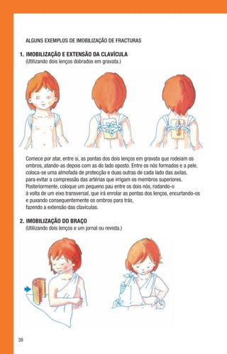 ALGUNS EXEMPLOS DE IMOBILIZAÇÃO DE FRACTURAS

1.	 Imobilização e extensão da clavícula
    (Utilizando dois lenços dobrados em gravata.)




     Comece por atar, entre si, as pontas dos dois lenços em gravata que rodeiam os
     ombros, atando-as depois com as do lado oposto. Entre os nós formados e a pele,
     coloca-se uma almofada de protecção e duas outras de cada lado das axilas,
     para evitar a compressão das artérias que irrigam os membros superiores.
     Posteriormente, coloque um pequeno pau entre os dois nós, rodando-o
     à volta de um eixo transversal, que irá enrolar as pontas dos lenços, encurtando-os
     e puxando consequentemente os ombros para trás,
     fazendo a extensão das clavículas.

2.	 Imobilização do braço
    (Utilizando dois lenços e um jornal ou revista.)




38
 