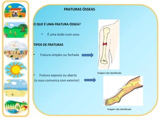 FRATURAS ÓSSEAS O QUE É UMA FRATURA ÓSSEA? É uma lesão num osso.  TIPOS DE FRATURAS Fratura simples ou fechada Fratura exposta ou aberta (o osso comunica com exterior) Imagem não identificada Imagem não identificada 