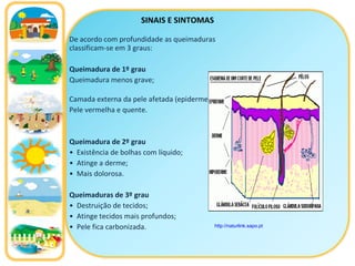 SINAIS E SINTOMAS De   acordo com profundidade as queimaduras classificam-se em 3 graus: Queimadura de 1º grau Queimadura menos grave;  Camada externa da pele afetada (epiderme); Pele vermelha e quente. Queimadura de 2º grau Existência de bolhas com líquido; Atinge a derme; Mais dolorosa. Queimaduras de 3º grau Destruição de tecidos; Atinge tecidos mais profundos; Pele fica carbonizada. http://naturlink.sapo.pt   