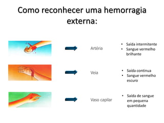 Como reconhecer uma hemorragia
           externa:

                               • Saída intermitente
                Artéria        • Sangue vermelho
                                 brilhante



                               • Saída continua
                Veia
                               • Sangue vermelho
                                 escuro


                               • Saída de sangue
                Vaso capilar     em pequena
                                 quantidade
 