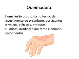 Queimadura:
É uma lesão produzida no tecido de
revestimento do organismo, por agentes
térmicos, elétricos, produtos
químicos, irradiação ionizante e animais
peçonhentos.
 