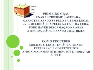 PRIMEIRO GRAU
     APENAS A EPIDERME É AFETADA,
CARACTERIZANDO-SE PELO ERITEMA LOCAL
(VERMELHIDÃO DA PELE). NA FASE DA CURA,
   PODE HAVER DESCAMAÇÃO NA ÁREA
  ATINGIDA, NÃO DEIXANDO CICATRIZES.


           COMO PROCEDER
   MOLHAR O LOCAL EM ÁGUA FRIA DE
      PREFERÊNCIA CORRENTE POR
APROXIMADAMENTE 15 MINUTOS E HIDRATAR
               A PELE.
 