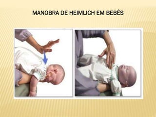 MANOBRA DE HEIMLICH EM BEBÊS
 