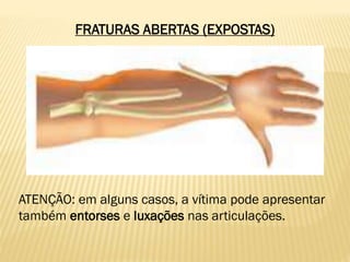 FRATURAS ABERTAS (EXPOSTAS)
ATENÇÃO: em alguns casos, a vítima pode apresentar
também entorses e luxações nas articulações.
 