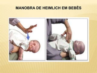 MANOBRA DE HEIMLICH EM BEBÊS
 