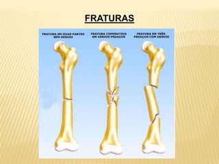 FRATURAS
 