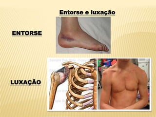 Entorse e luxação
ENTORSE
LUXAÇÃO
 