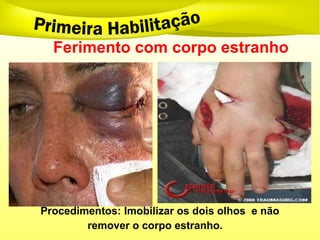 Ferimento com corpo estranho
Procedimentos: Imobilizar os dois olhos e não
remover o corpo estranho.
 