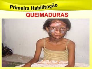 QUEIMADURAS
 