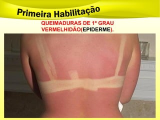 QUEIMADURAS DE 1º GRAU
VERMELHIDÃO(EPIDERME).
 