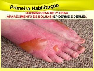QUEIMADURAS DE 2º GRAU
APARECIMENTO DE BOLHAS (EPIDERME E DERME).
 