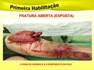 FRATURA ABERTA (EXPOSTA)
O OSSO SE QUEBRA E Á O ROMPIMENTO DA PELE
 