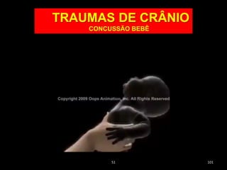 51 101
TRAUMAS DE CRÂNIO
CONCUSSÃO BEBÊ
 