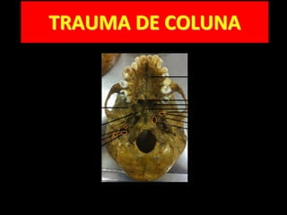 TRAUMA DE COLUNA
 