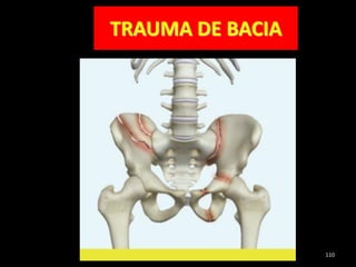 TRAUMA DE BACIA
110
 