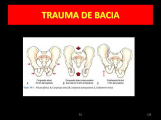 51 111
TRAUMA DE BACIA
 