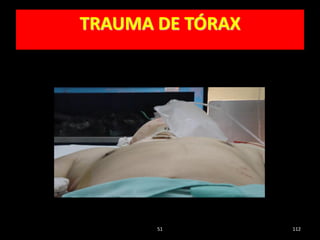 51 112
TRAUMA DE TÓRAX
 