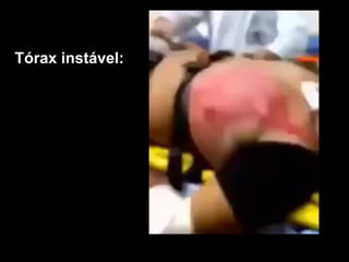 Tórax instável:
 