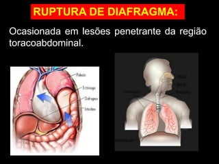Ocasionada em lesões penetrante da região
toracoabdominal.
RUPTURA DE DIAFRAGMA:
 