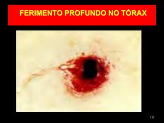 FERIMENTO PROFUNDO NO TÓRAX
135
 