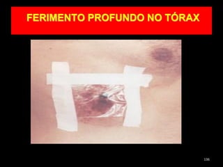 FERIMENTO PROFUNDO NO TÓRAX
136
 