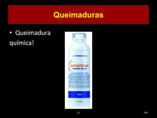 • Queimadura
química!
51 144
Queimaduras
 
