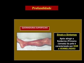 Sinais e Sintomas
Após atingir a
Epiderme (Primeira
camada) da pele é
caracterizada por DOR
e VERMELHIDÃO
Profundidade
QUEIMADURAS SUPERFICIAIS
 