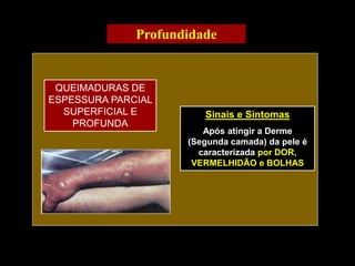 Sinais e Sintomas
Após atingir a Derme
(Segunda camada) da pele é
caracterizada por DOR,
VERMELHIDÃO e BOLHAS
QUEIMADURAS DE
ESPESSURA PARCIAL
SUPERFICIAL E
PROFUNDA
Profundidade
 