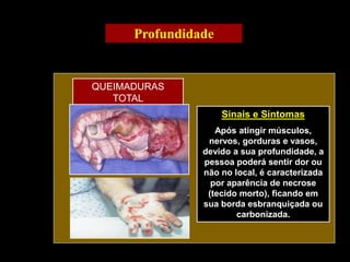 Sinais e Sintomas
Após atingir músculos,
nervos, gorduras e vasos,
devido a sua profundidade, a
pessoa poderá sentir dor ou
não no local, é caracterizada
por aparência de necrose
(tecido morto), ficando em
sua borda esbranquiçada ou
carbonizada.
QUEIMADURAS
TOTAL
Profundidade
 