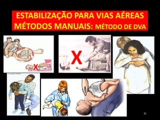 ESTABILIZAÇÃO PARA VIAS AÉREAS
MÉTODOS MANUAIS: MÉTODO DE DVA
51 31
X
X
 