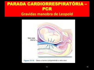 51 41
PARADA CARDIORRESPIRATÓRIA –
PCR
Gravidas manobra de Leopold
 