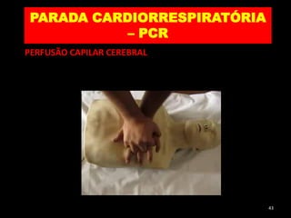 PARADA CARDIORRESPIRATÓRIA
– PCR
43
PERFUSÃO CAPILAR CEREBRAL
 