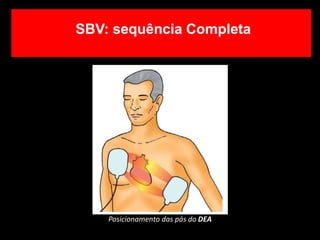 Posicionamento das pás do DEA
SBV: sequência Completa
 