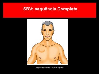 Aparência do MP sob a pele
SBV: sequência Completa
 