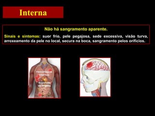Interna
Não há sangramento aparente.
Sinais e sintomas: suor frio, pele pegajosa, sede excessiva, visão turva,
arroxeamento da pele no local, secura na boca, sangramento pelos orifícios.
 