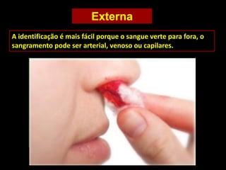 Externa
A identificação é mais fácil porque o sangue verte para fora, o
sangramento pode ser arterial, venoso ou capilares.
 